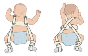 Arnes De Pavlick Displasia Cadera Niños Infantil Ortopedia - Imagen 11